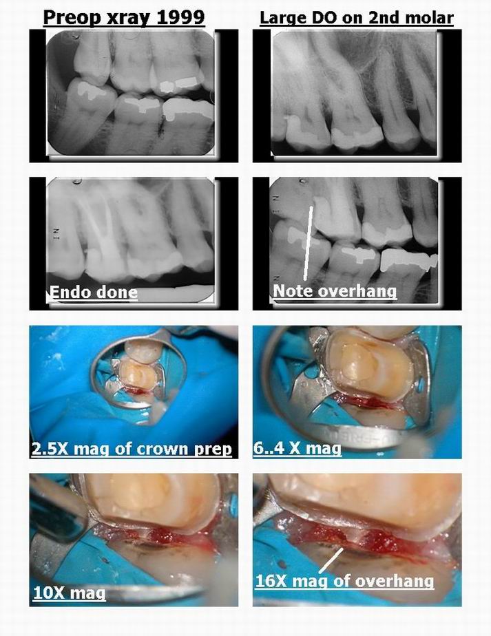 Resize of Troughing on deep distal pg 1.jpg